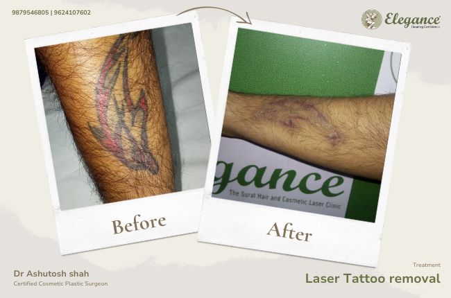 Laser Tattoo removal (4)