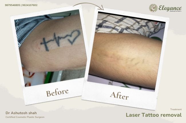 Laser Tattoo removal (5)