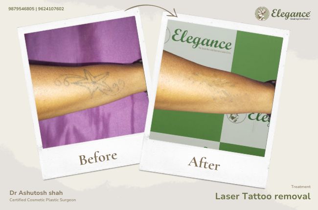 Laser Tattoo removal (6)