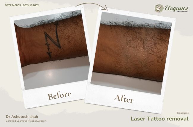 Laser Tattoo removal