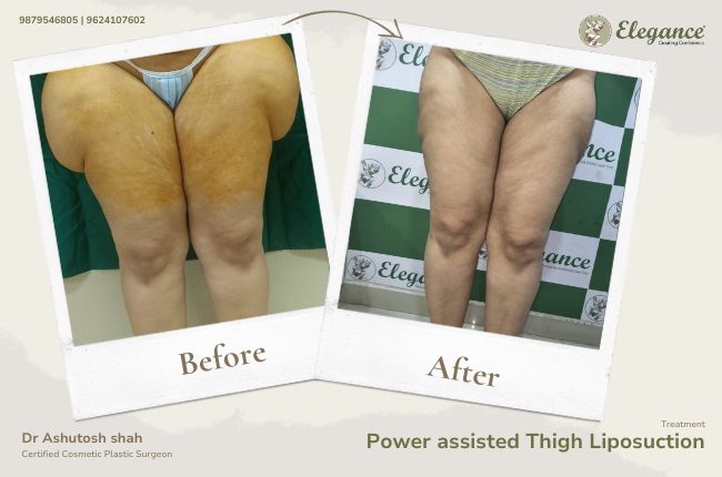 Lateral thigh Bulge Liposuction (2)