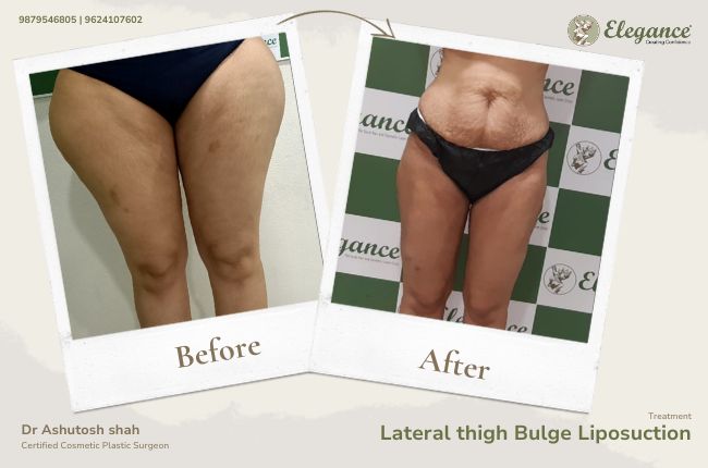 Lateral thigh Bulge Liposuction