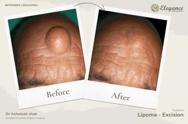 Lipoma - Excision