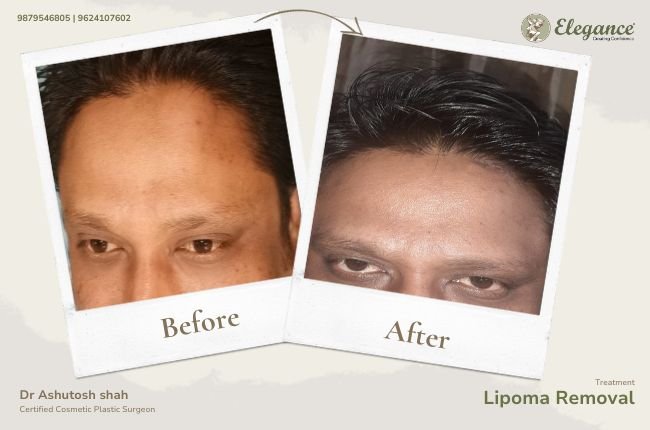 Lipoma Removal