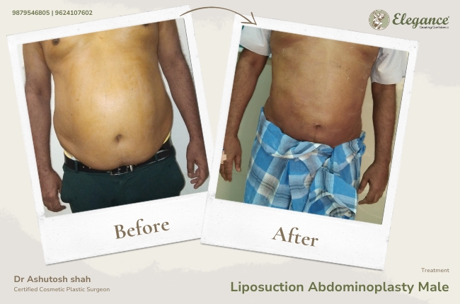 Liposuction Abdominoplasty Male 19
