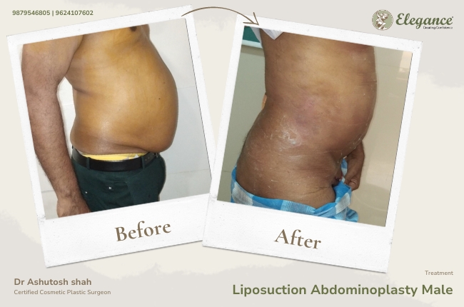Liposuction Abdominoplasty Male 21