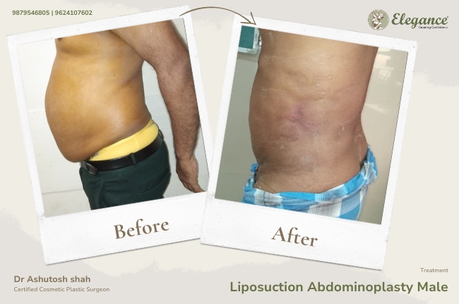 Liposuction Abdominoplasty Male 22