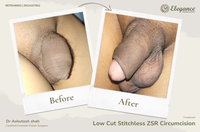 Low Cut Stitchless ZSR Circumcision