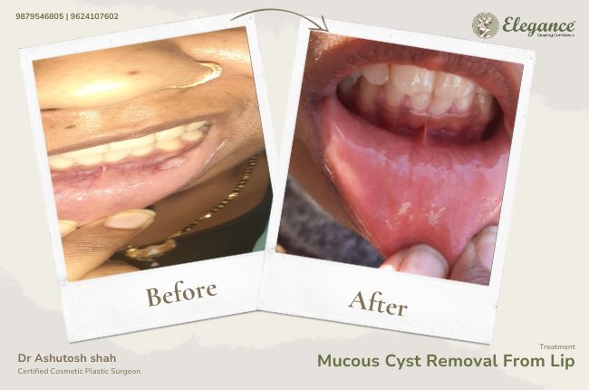 Mucous Cyst Removal From Lip