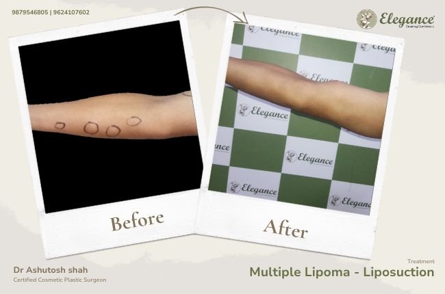 Multiple Lipoma - Liposuction