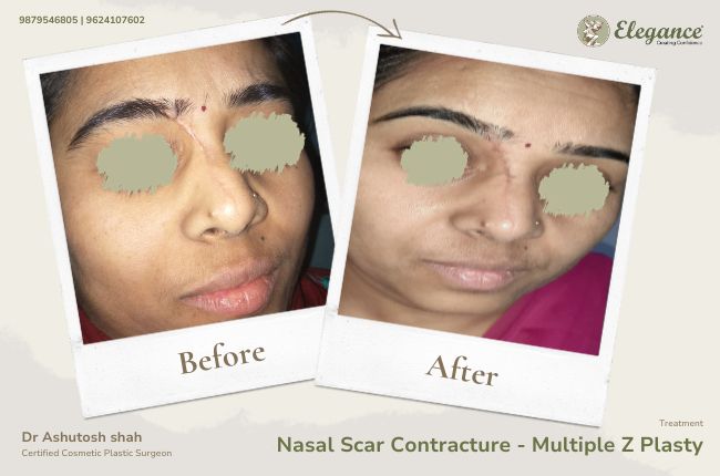 Nasal Scar Contracture - Multiple Z Plasty