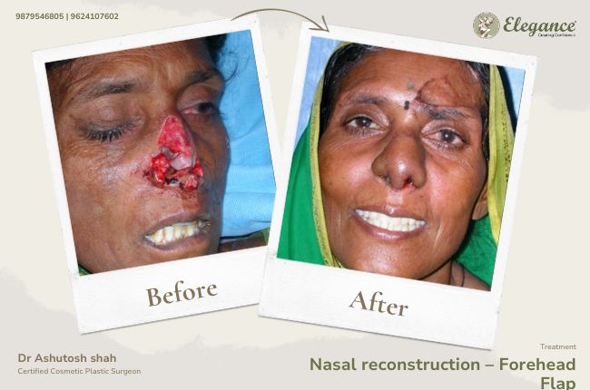 Nasal reconstruction – Forehead Flap