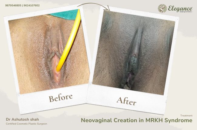 Neovaginal Creation in MRKH Syndrome