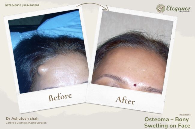 Osteoma – Bony Swelling on Face