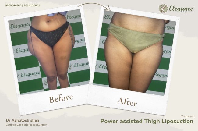 Power assisted Thigh Liposuction
