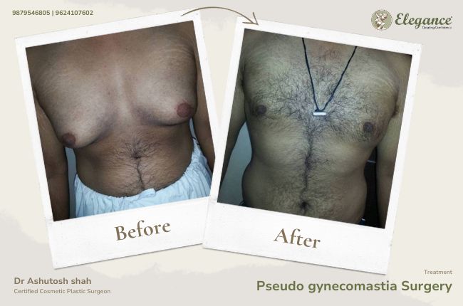 Pseudo gynecomastia Surgery