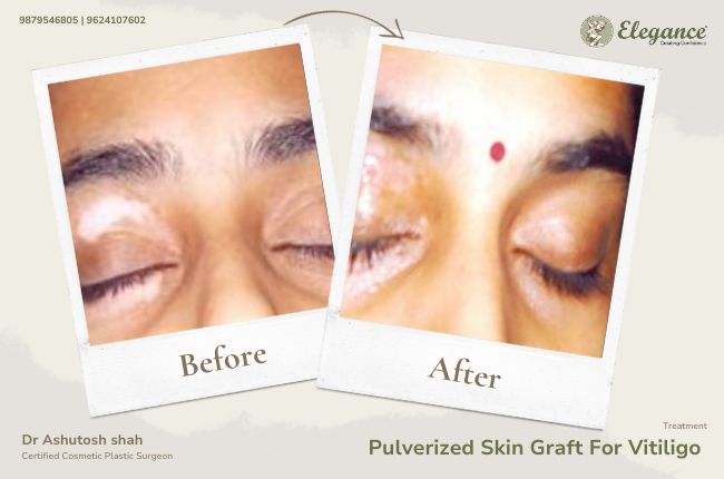 Pulverized Skin Graft For Vitiligo (2)