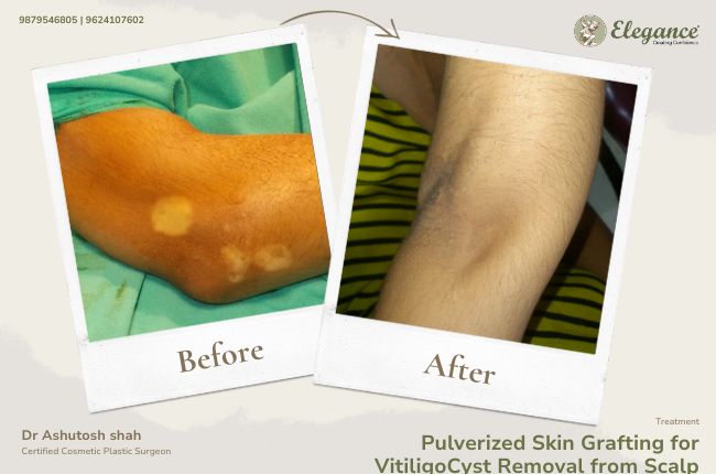 Pulverized Skin Grafting for Vitiligo