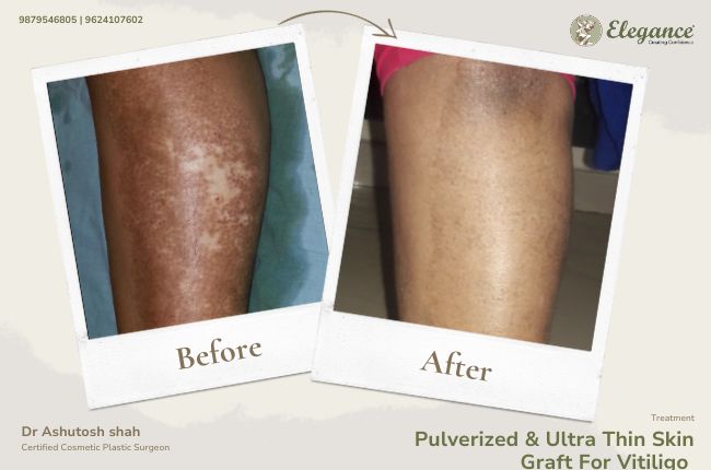 Pulverized _ Ultra Thin Skin Graft For Vitiligo