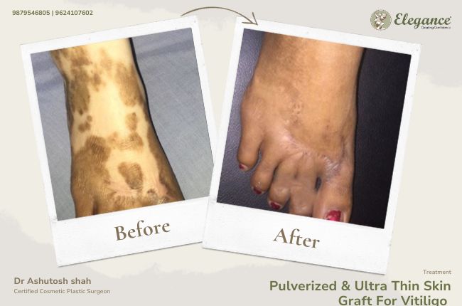 Pulverized _ Ultra Thin Skin Graft For Vitiligo (2)