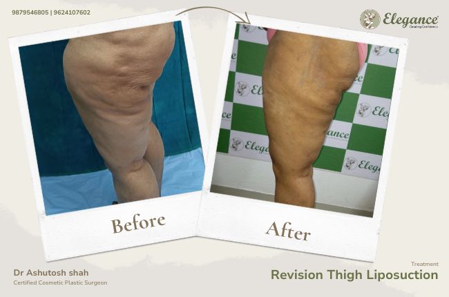 Revision Thigh Liposuction (1)
