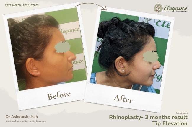 Rhinoplasty- 3 months result Tip Elevation 27