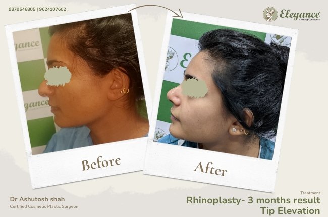 Rhinoplasty- 3 months result Tip Elevation 28