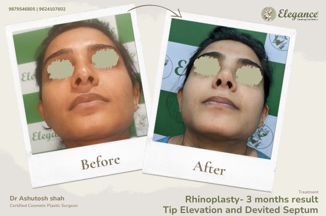 Rhinoplasty- 3 months result Tip Elevation and Devited Septum 24