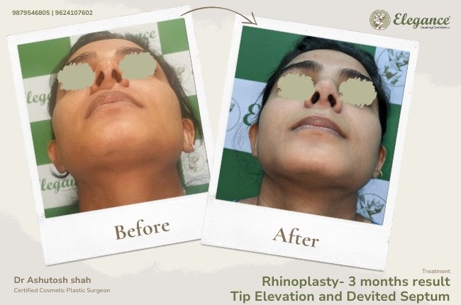 Rhinoplasty- 3 months result Tip Elevation and Devited Septum 25