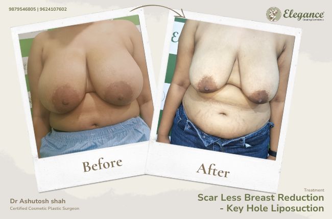 Scar Less Breast Reduction- Key Hole Liposuction (2)