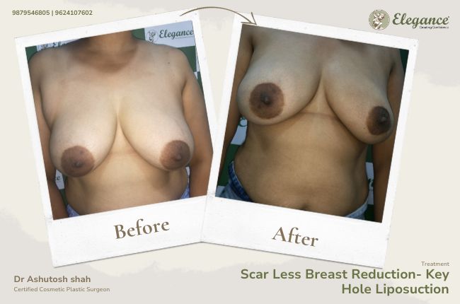 Scar Less Breast Reduction- Key Hole Liposuction (3)