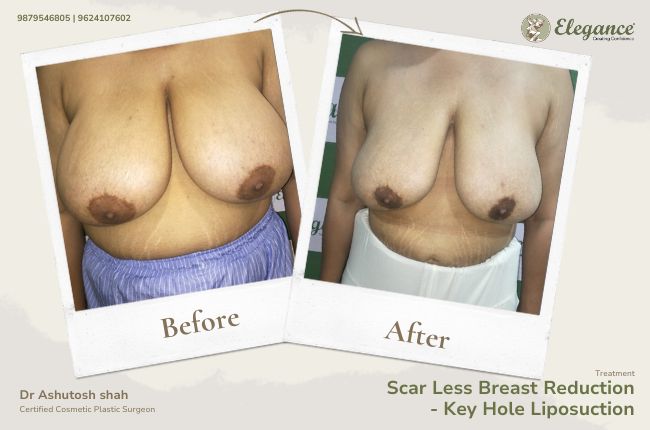 Scar Less Breast Reduction- Key Hole Liposuction