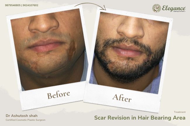 Scar revision in hair bearing area