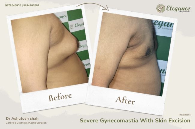 Severe Gynecomastia With Skin Excision (2)