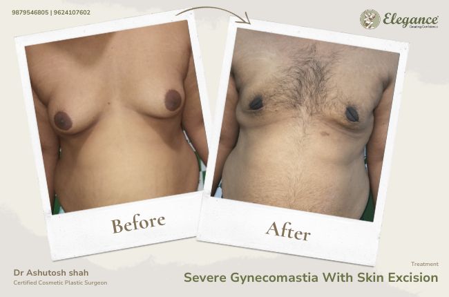 Severe Gynecomastia With Skin Excision (3)