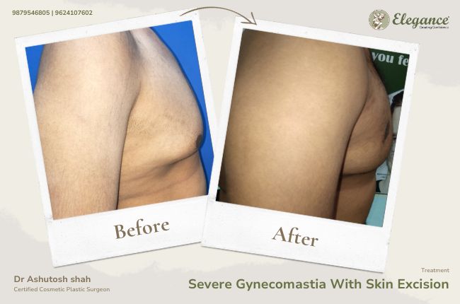 Severe Gynecomastia With Skin Excision (5)