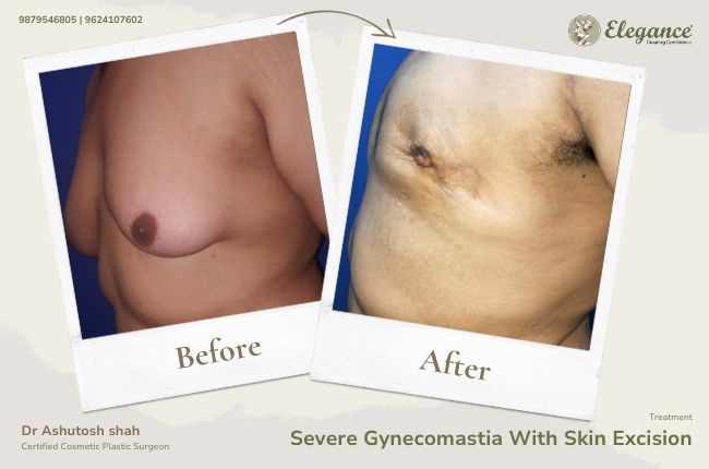 Severe Gynecomastia With Skin Excision (6)