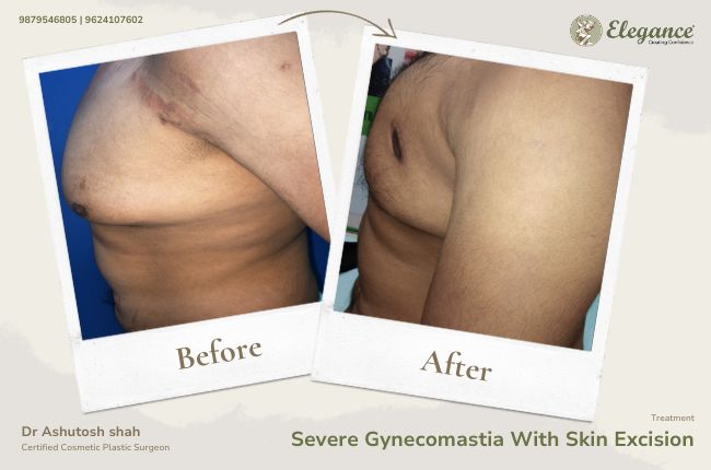 Severe Gynecomastia With Skin Excision (8)