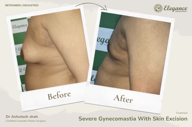 Severe Gynecomastia With Skin Excision