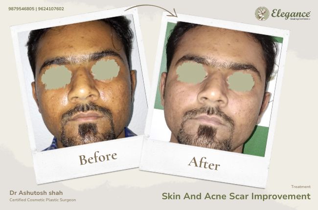 Skin And Acne Scar Improvement