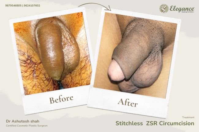 Stitchless ZSR Circumcision