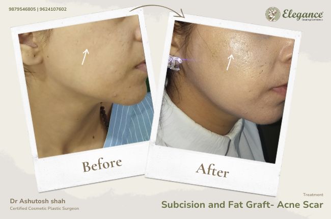 Subcision and Fat Graft- Acne Scar (2)