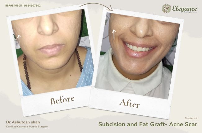 Subcision and Fat Graft- Acne Scar