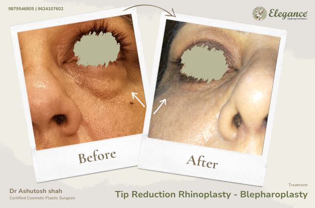 Tip Reduction Rhinoplasty - Blepharoplasty