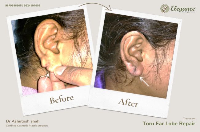 Torn Ear Lobe Repair