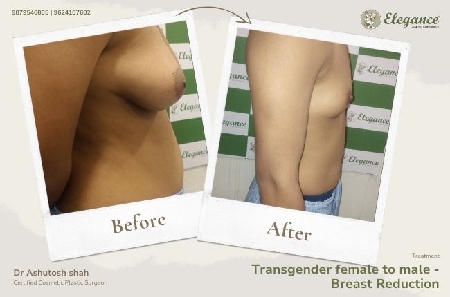 Transgender female to male - Breast Reduction (2)