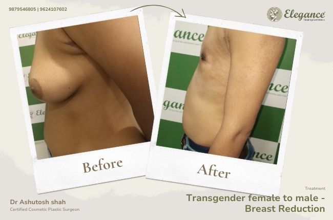 Transgender female to male - Breast Reduction (3)