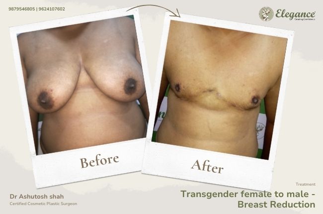 Transgender female to male - Breast Reduction