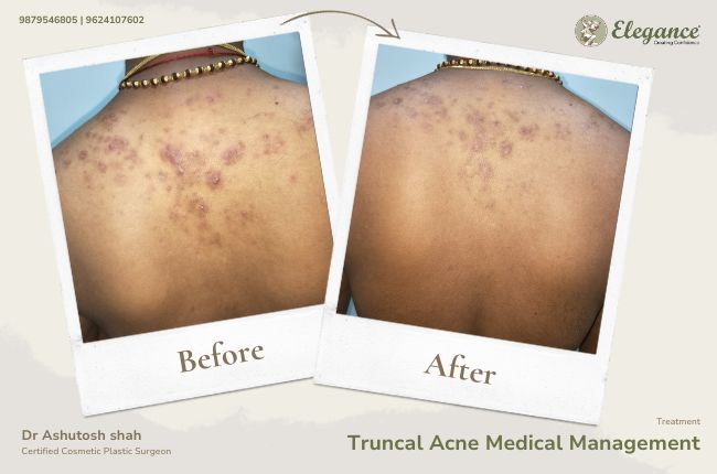 Truncal Acne Medical Management (3)