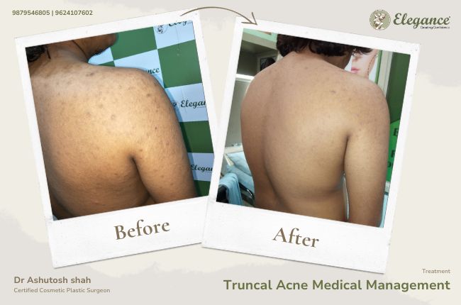 Truncal Acne Medical Management